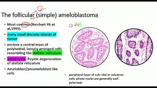 Ameloblastoma HISTOPATHOLOGYtypesRadiographic featuresclinical featuresOdontogenic tumors [upl. by Dody87]