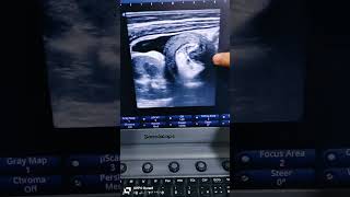 intussusception by ultrasound and evaluation تشخيص وشرح الحاله مباشر من العياده [upl. by Yelmene]