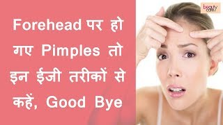 Get Rid of Forehead Pimples with these Easy Ways Hindi [upl. by Themis]