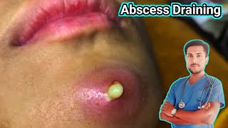 Abscess Treatment Causes Symptoms and Removalquot [upl. by Lauber]