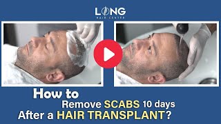 How to remove scabs 10 days after a hair transplant ll Long Hair Center [upl. by Ethelstan]