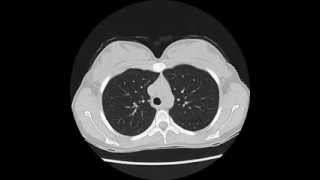 Normal Chest CT  using quotlung windowsquot [upl. by Barden]