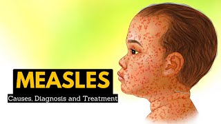 Measles Causes Signs and Symptoms Diagnosis and Treatment [upl. by Nameerf]