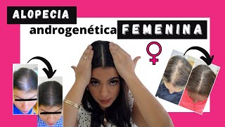 👩🏽Calvicie Femenina👩🏻‍🦰 Alopecia Androgenética Femenina🚺 [upl. by Acinonrev]