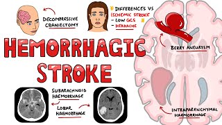 Hemorrhagic Stroke  Intracerebral Hemorrhage amp Subarachnoid Hemorrhage  Management [upl. by Oidivo169]