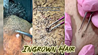 Removing Ingrown Hair Compilation  Body Care Compilation 👣 [upl. by Enilatan]