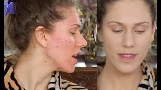 Acne Scar Foundation Routine  Full Coverage Flawless Makeup Tutorial  Pores amp Ice Pick Scarring [upl. by Noterb]