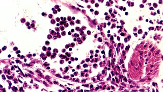 Acute Inflammation  Definition Pathogenesis Causes Mediators Morphology Exudate and Transudate [upl. by Raseac]