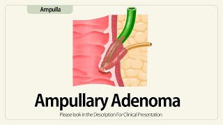 Ampullary Adenoma [upl. by Marian705]