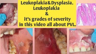 Leukoplakia and DysplasiaLeukoplakia amp its grades of severitythis video all type Leukoplakiaamp PVL [upl. by Erbua]