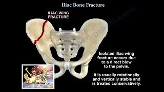 Iliac Bone Fracture  Everything You Need To Know  Dr Nabil Ebraheim [upl. by Donovan]