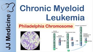 Chronic Myeloid Leukemia CML  Pathogenesis Symptoms and Treatment [upl. by Curry]