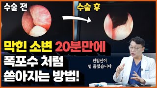 막힌 소변이 20분만에 폭포수처럼 쏟아지는 방법 전립선 시술 유로리프트 [upl. by Siugram]