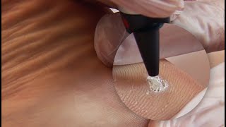 Plantar Wart Treatment [upl. by Enimasaj]