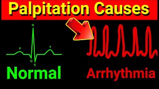 Why Your Heart is Racing Top 5 Causes of Palpitations Arrythmia vs Palpitations [upl. by Eniamraj71]