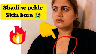 shadi se pehle SKIN BURN 😭 Life update 3 [upl. by Romano]