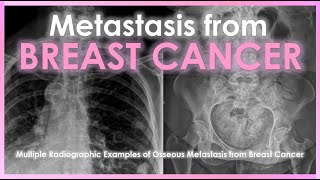 Metastasis from Breast Cancer radiology breastcancer health [upl. by Yve985]