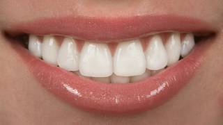 Difference Between Crowns and Veneers [upl. by Rebmik]