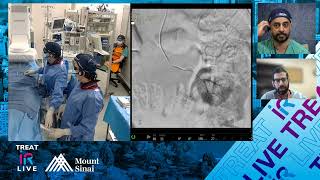 Transradial Embolization of Multiple Renal Angiomyolipomas using LAVA Liquid Embolic System [upl. by Airliah]