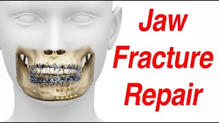 Jaw Fracture Surgical Treatment Animation MMF  ORIF [upl. by Arihsay]