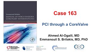 Case 163 Manual of PCI  PCI through CoreValve [upl. by Giles785]