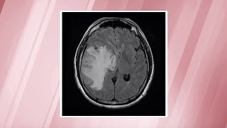 Glioblastoma—the most commonlydiagnosed brain cancer  OSUCCC – James [upl. by Nesilla124]