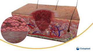 Wound Healing [upl. by Yregram]