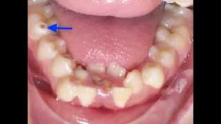 Lower Incisor Extraction Time Lapse Video Kyger Orthodontics [upl. by Blondell]