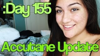 Day 155 Accutane SEVERE Acne Update Why I stopped taking Accutane [upl. by Arrol]