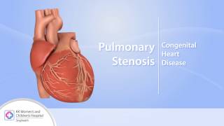 Heart Conditions – Pulmonary Stenosis [upl. by Munn]