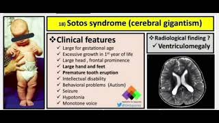 🌀 Sotos syndrome 🌀 [upl. by Alissa487]