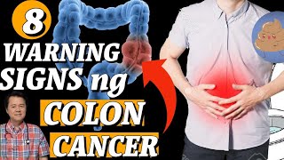 8 Warning Signs ng Colon Cancer  Tips by Doc Willie Ong 1081b [upl. by Chas]