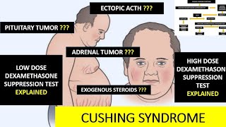 Dexamethasone suppression test DST  Cushings syndrome [upl. by Aridan23]