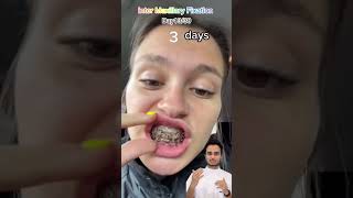 Day 1330 days  Jaw Surgery surgery plasticsurgery [upl. by Yelrahc]