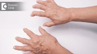 Signs and symptoms of Rheumatoid Arthritis  Dr Prashanth Jain [upl. by Kcolttam113]