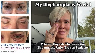 Blepharoplasty Week 1  Recovery amp What to Expect Eyelid Surgery amp CO2 Channeling Luxury Beauty [upl. by Edgard]