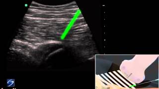 How To Hip UltrasoundGuided Injection of the Proximal Hamstring 3D Video [upl. by Nevaeh]