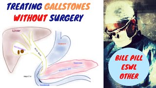 Treating Gallstones WITHOUT Surgery [upl. by Ayamat]