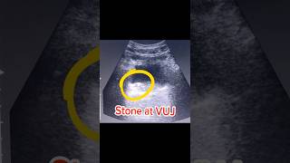 Ureteric Stone  VUJ Stone  Bladder Stone on Ultrasound [upl. by Savihc]