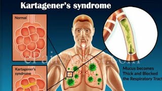 Kartagener syndrome trick  ENT important question [upl. by Eisso]