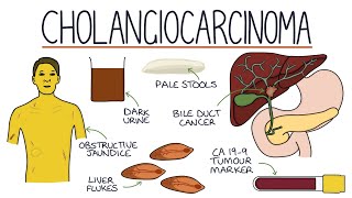 Understanding Cholangiocarcinoma [upl. by Ragucci]