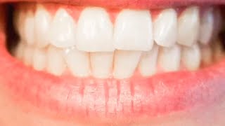 ¿Cómo prevenir la caries en los dientes [upl. by Edurtreg67]