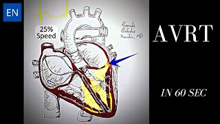 Atrioventricular Reentrant Tachycardia AVRT Animation and ECG Shorts [upl. by Dlonra]