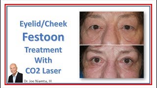 Festoon Treatment with CO2 Laser [upl. by Gottfried366]