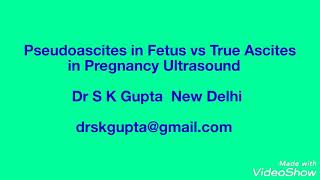 Pseudoascites vs True Ascites in Fetus on Ultrasound [upl. by Llehcar]