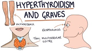 Understanding Hyperthyroidism and Graves Disease [upl. by Eylatan]