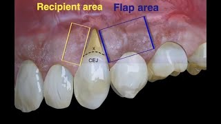 Laterally moved coronally advanced flap [upl. by Hastings667]