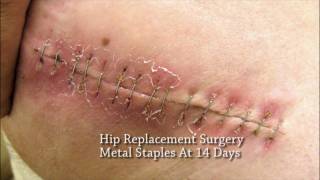 A More Patient Centric Solution To Metal Skin Staples in Surgery Absorbable Skin Staples [upl. by Oidualc]