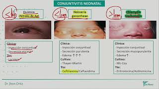 Neonatología  Conjuntivitis neonatal [upl. by Cloe]