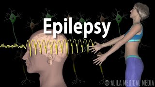 Epilepsy Types of seizures Symptoms Pathophysiology Causes and Treatments Animation [upl. by Adnama534]